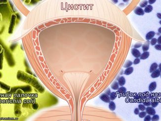 Цистит - воспаление мочевого пузыря